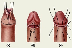 Обрезание крайней плоти - циркумизация, интимная пластика для мужчин