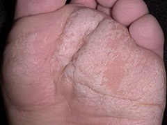 Мацерация кожи стопы
