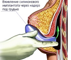 Маммопластика - коррекция формы и/или размера груди