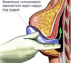 Маммопластика