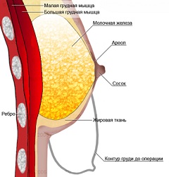 Операция по уменьшению груди называется редукционной маммопластикой