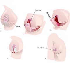 Принцип операции по уменьшению груди