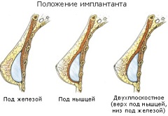 Варианты расположения имплантов для увеличения груди