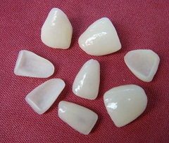 Виниры - специальные пластинки для покрытия зубов