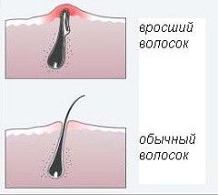 Как выглядят вросшие волосы после эпиляции?