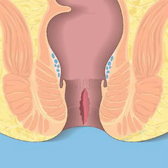 Анальная трещина зачастую может не иметь явных симптомов