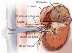 Расположение ангиомиолипомы почки