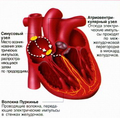 Приступ атриовентрикулярной блокады