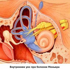 Механизм развития болезни Меньера