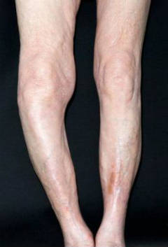 При болезни Педжета ноги приобретают X- или О-образную форму