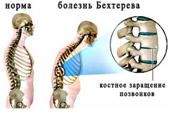 Воспаление межпозвоночных суставов - болезнь Бехтерева