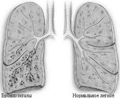 Отличие нормального легкого от больного бронхоэктазом