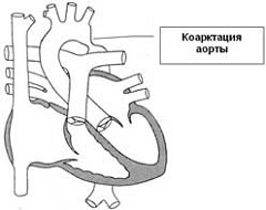 Коарктация аорты - врожденное заболевание