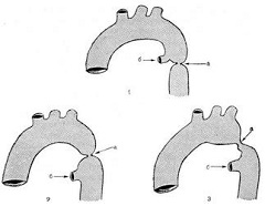 Варианты коарктации аорты