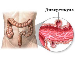 Дивертикулез - образование на стенках кишечника дивертикул