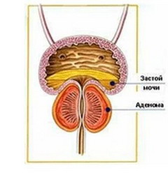 Механизм образования доброкачественной гиперплазии предстательной железы