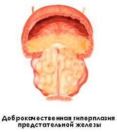 Узел доброкачественной гиперплазии предстательной железы