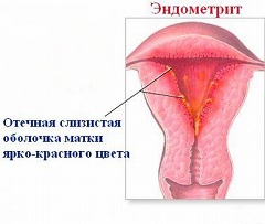 Сильная боль внизу живота - признак эндометрита