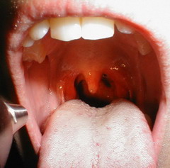 Выраженными симптомами фаринготрахеита при осмотре горла и глотки является покраснение стенок