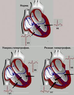 Стадии гипертрофии правого желудочка