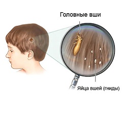 Гниды - яйца вшей