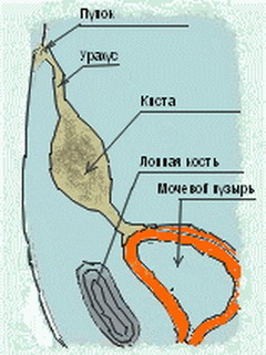 Киста урахуса может достигать величины человеческого кулака