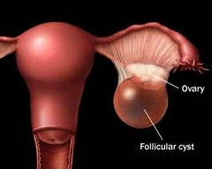 Опасность кисты желтого тела - перекрут ножки или разрыв ее капсулы