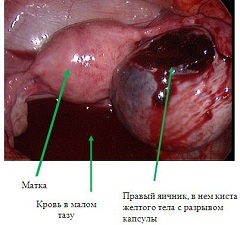 Киста желтого тела с разрывом капсулы