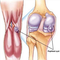 Киста коленного сустава - киста в подколенной ямке