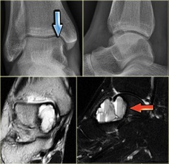 Киста голеностопного сустава на снимках МРТ