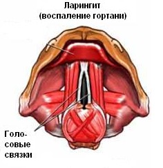 Соблюдение правил поможет меньше болеть острым ларингитом и может предотвратить хронический ларингит 