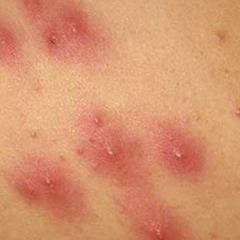 Лихорадка Денге представляет собой инфекционное вирусное заболевание