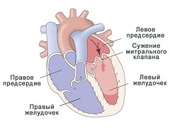 Митральный стеноз - приобретенный порок сердца