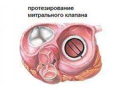 Протезирование митрального клапана - один из методов лечения митрального стеноза