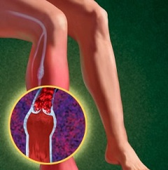 Боль после физической нагрузки - один из первых симптомов нарушения кровообращения нижних конечностей