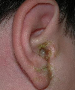 К симптомам наружного отита относят зеленые или темно-серые выделения из ушного канала
