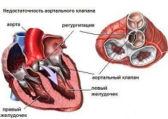 Недостаточность аортального клапана - порок сердца