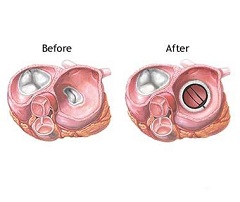 Замена клапана - хирургический способ лечения недостаточности аортального клапана
