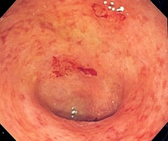 Неспецифический язвенный колит - язвенно-воспалительное поражение слизистой оболочки толстого кишечника