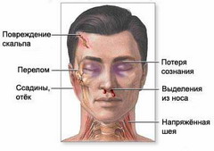 Перелом основания черепа - это опаснейшая травма