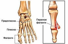 Диагностика перелома пальца ноги