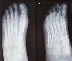 Более точную информацию о переломе пальца ноги может показать рентген