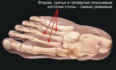 Вследствие перелома стопы могут развиться заболевания опорно-двигательного аппарата