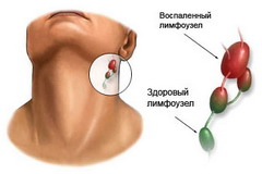Подчелюстной лимфаденит – это распространенная воспалительная патология 