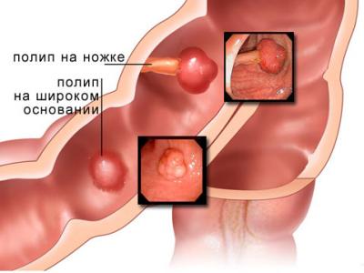 Полипы прямой кишки - доброкачественные новообразования