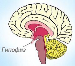 Пролактинома - доброкачественная опухоль гипофиза