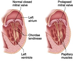 Пролапс митрального клапана - провисание его створок