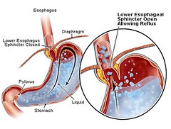 Рефлюкс-эзофагит - заброс желудочного содержимого в пищевод