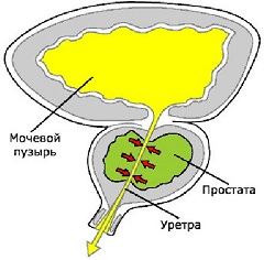 Простатит - воспаление предстательной железы у мужчин