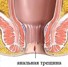 Механическая травма - одна из причин трещины прямой кишки